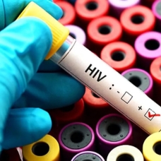 HIV virüsü tanıda geç kalınırsa AIDS'e dönüşüyor