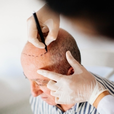 Saç ekimi hataları düzeltilmesi zor bir işlem